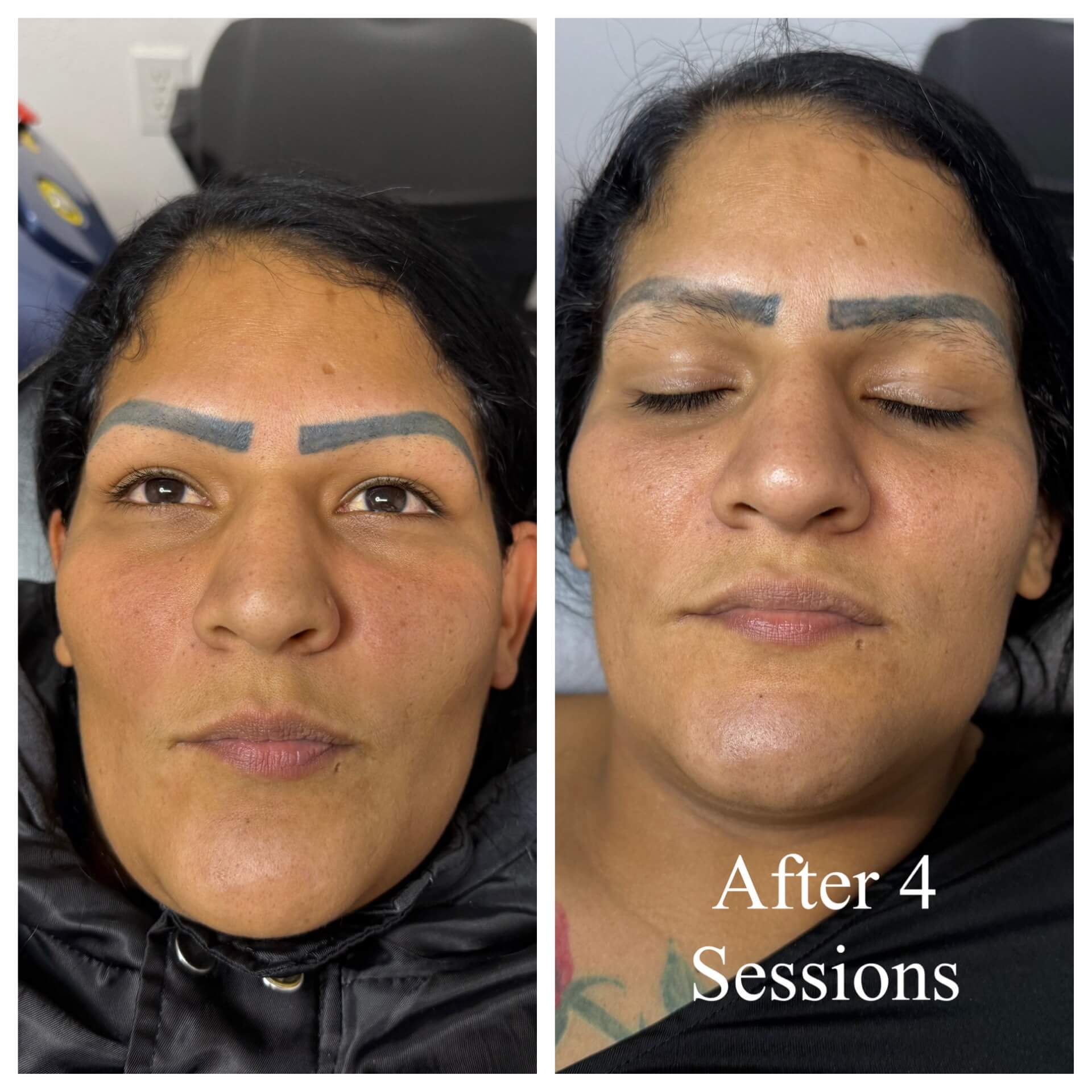  Bradenton Safe Tattoo Removals