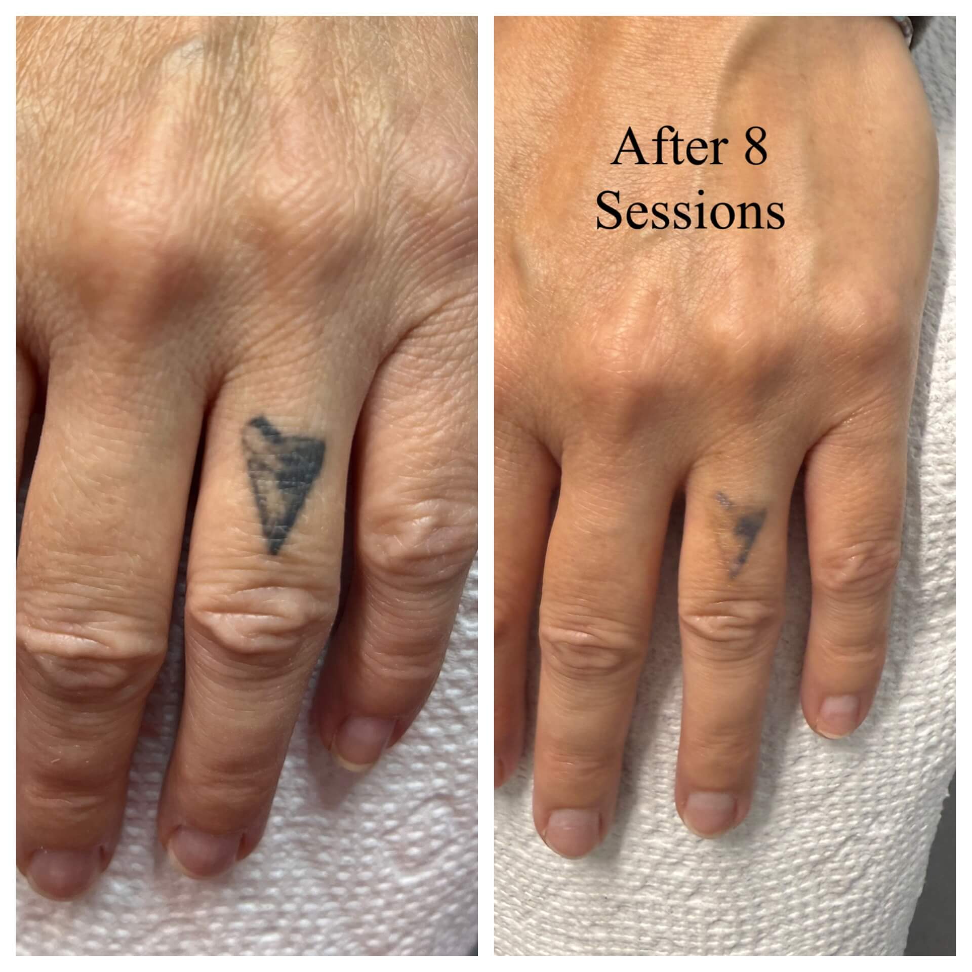 Mediyag Machine Tattoo Removals