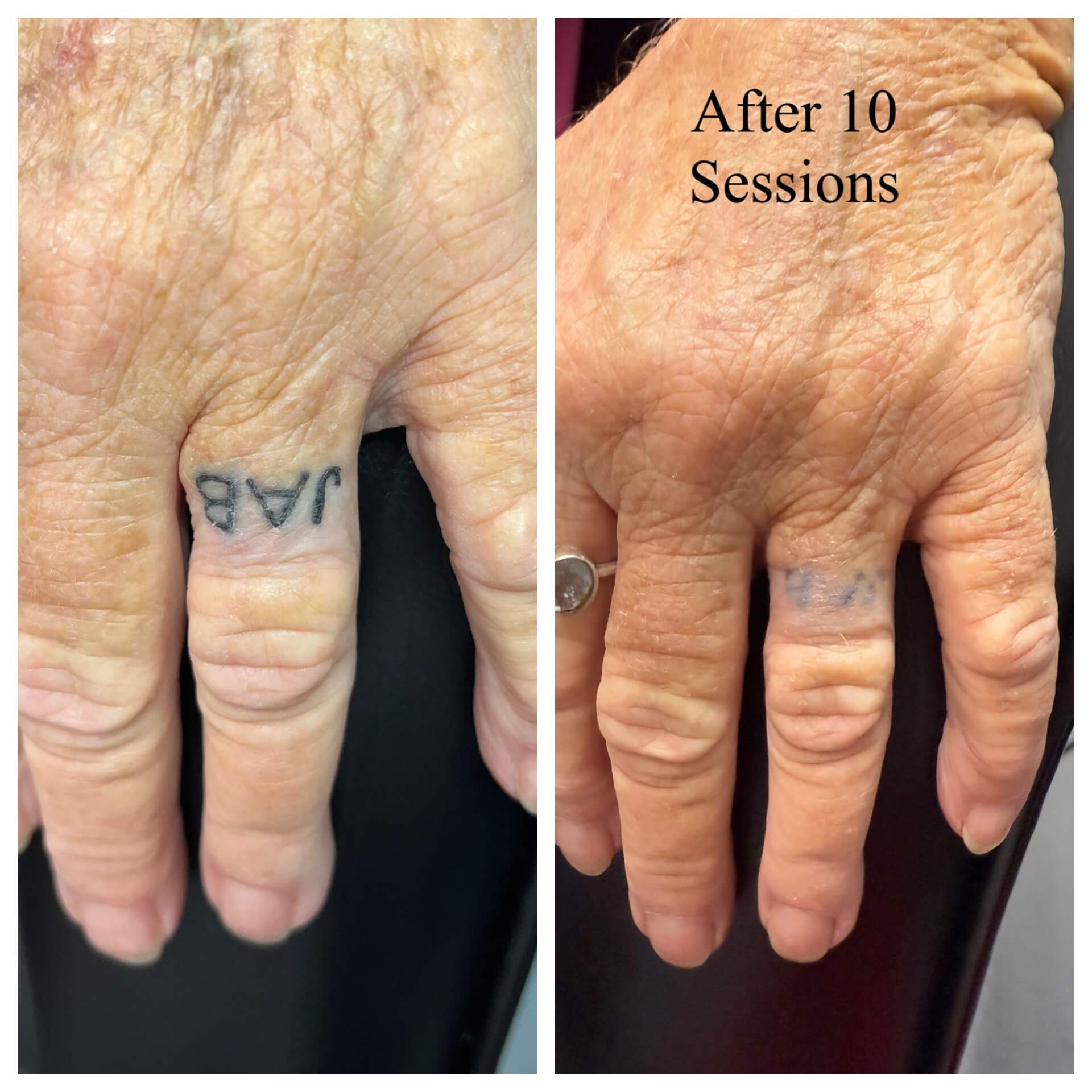 GExample of progress removing a tattoo