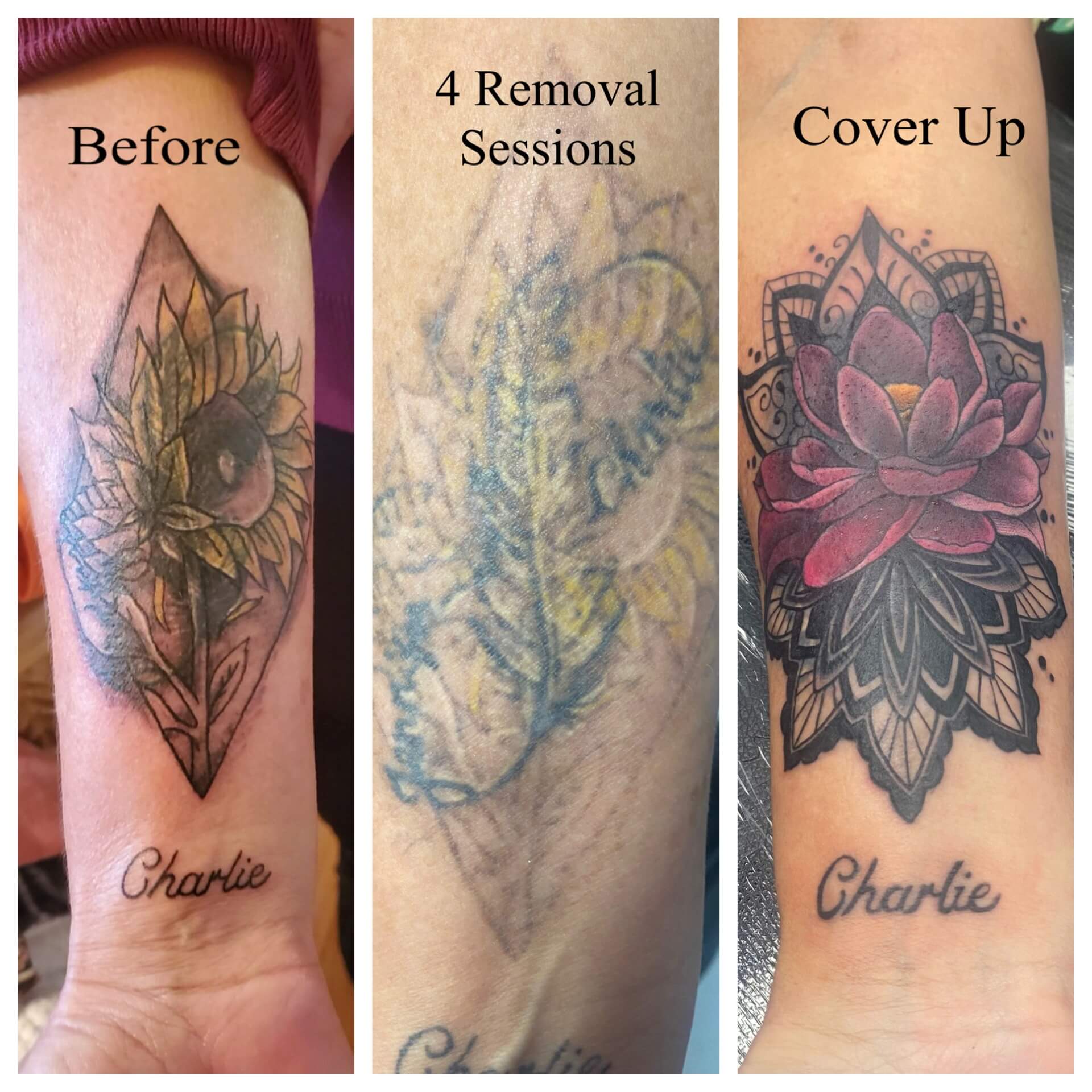  Tattoo Removal and Cover Up Tattoos in Bradenton, Manatee, South West Florida